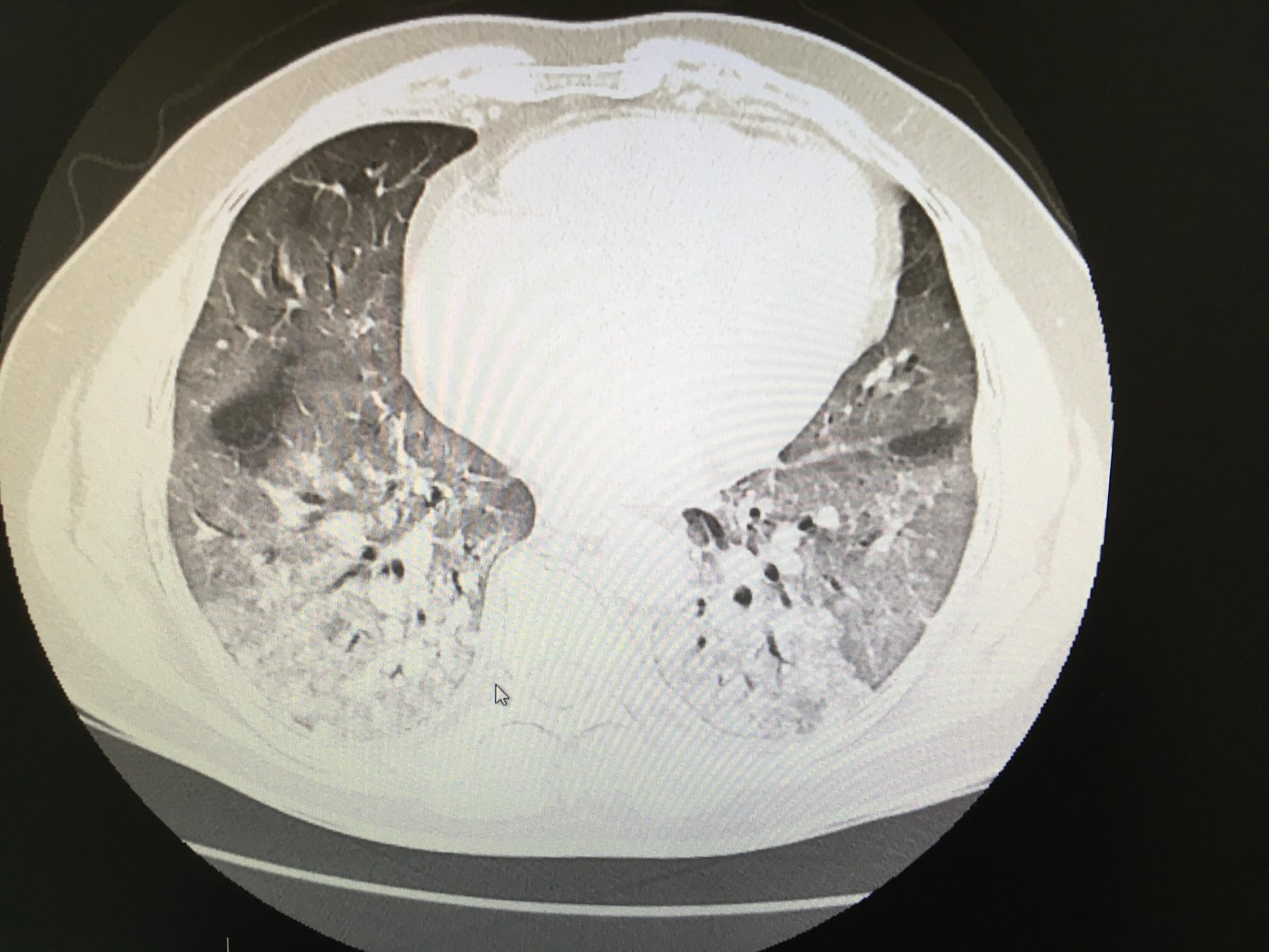 Tak wyglądają płuca zakażonego COVID-19: „Ten człowiek ich już nie ma”! [VIDEO] - Zdjęcie główne
