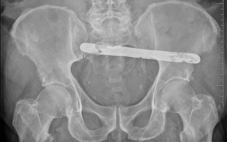 SKANDAL! Po operacji pacjentowi zaszyto 19-centymetrową metalową szpatułkę! Jest finał sprawy! - Zdjęcie główne