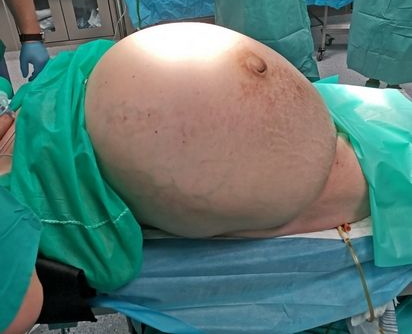 Jasielscy lekarze zoperowali guza giganta. Ważył 30kg! - Zdjęcie główne