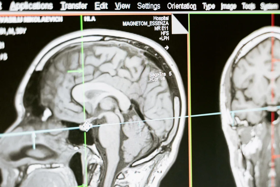 Gwałtownie rośnie liczba niedokrwiennych udarów mózgu. Będzie ich jeszcze więcej. Sprawdź, czy jesteś w grupie ryzyka - Zdjęcie główne