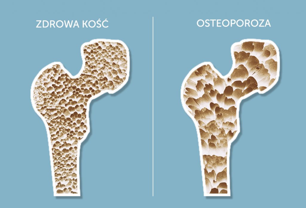 Mobilna pracownia densytometryczna – OSTEOBUS w Sanoku. Skorzystaj i przebadaj się! - Zdjęcie główne