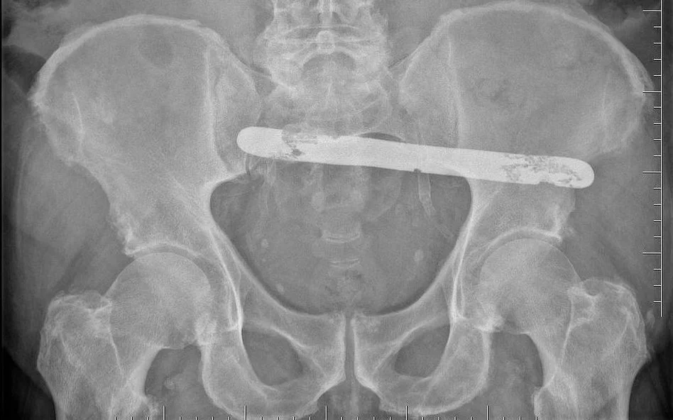 PODKARPACIE. Pacjentowi zaszyto w brzuchu 19-centymetrową metalową szpatułkę! - Zdjęcie główne